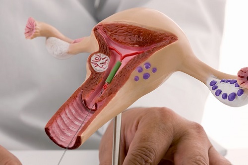 Intrauterine Insemination (IUI)